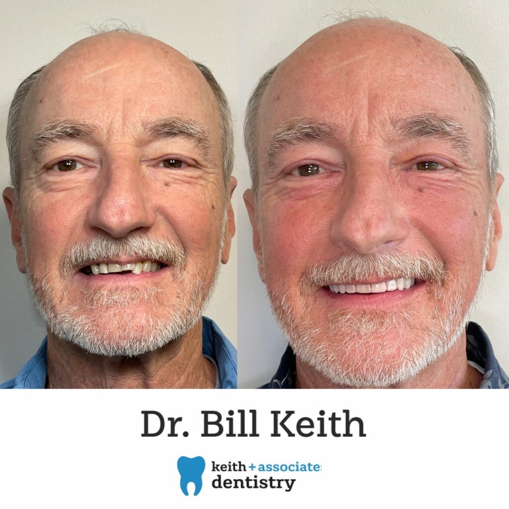 before and after full mouth dental implants