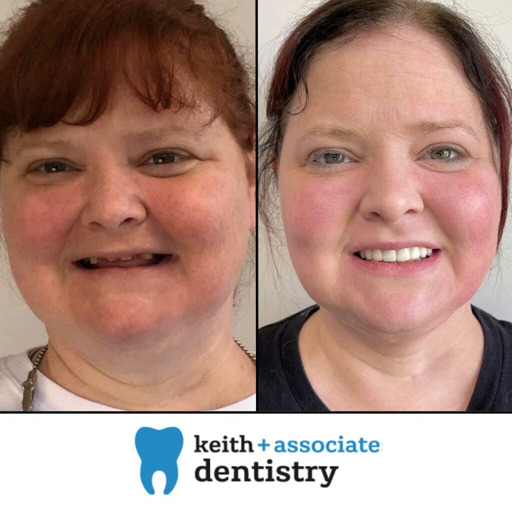woman before and after full mouth dental implants